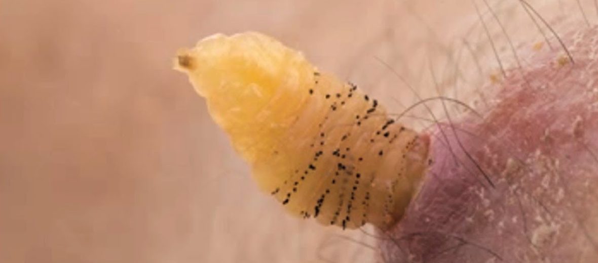 bot fly larvae human skin